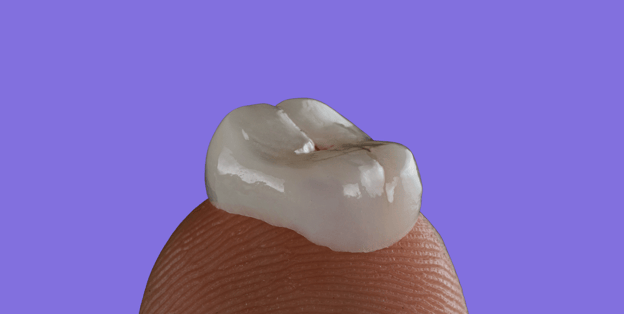 A dental Onlay