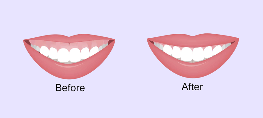 Gingivectomy Before and After 2 (1)