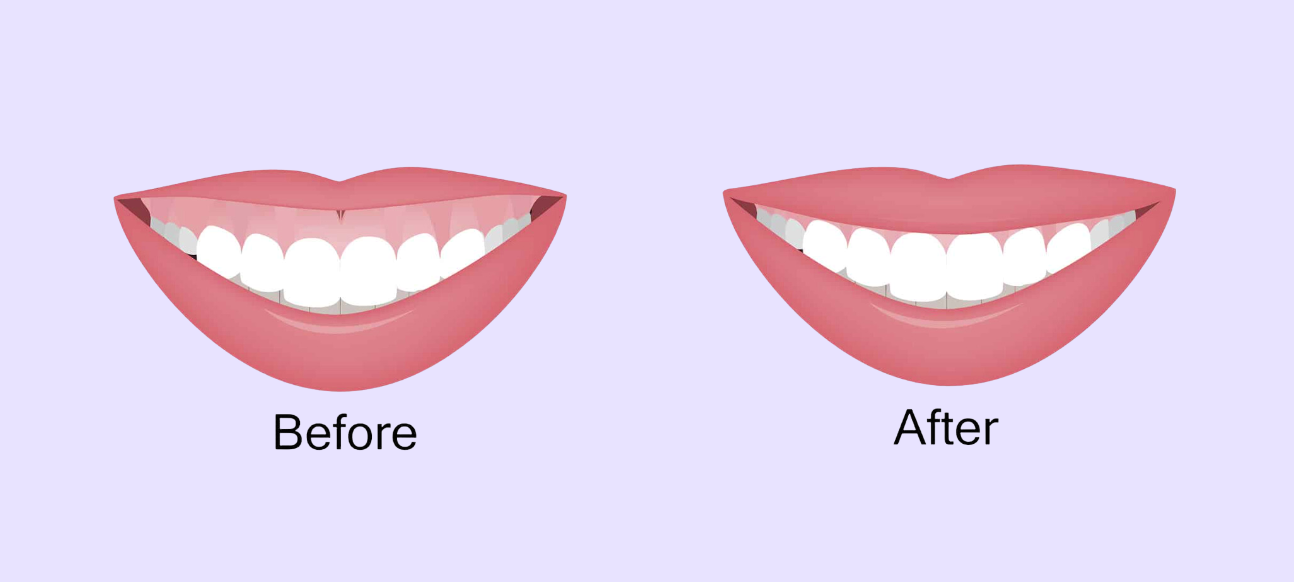 Gingivectomy Before and After