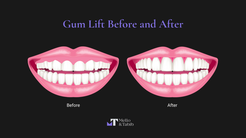 Gingivectomy Before and After 4