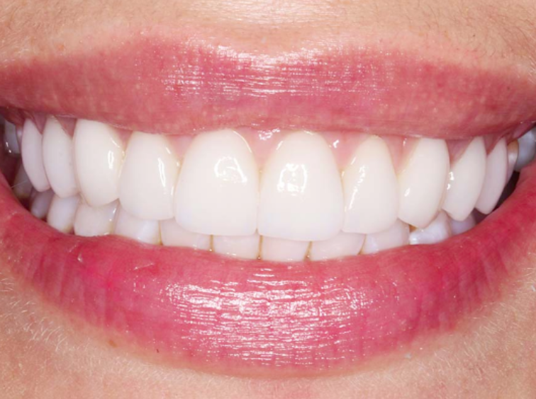 A close up of a patient smiling