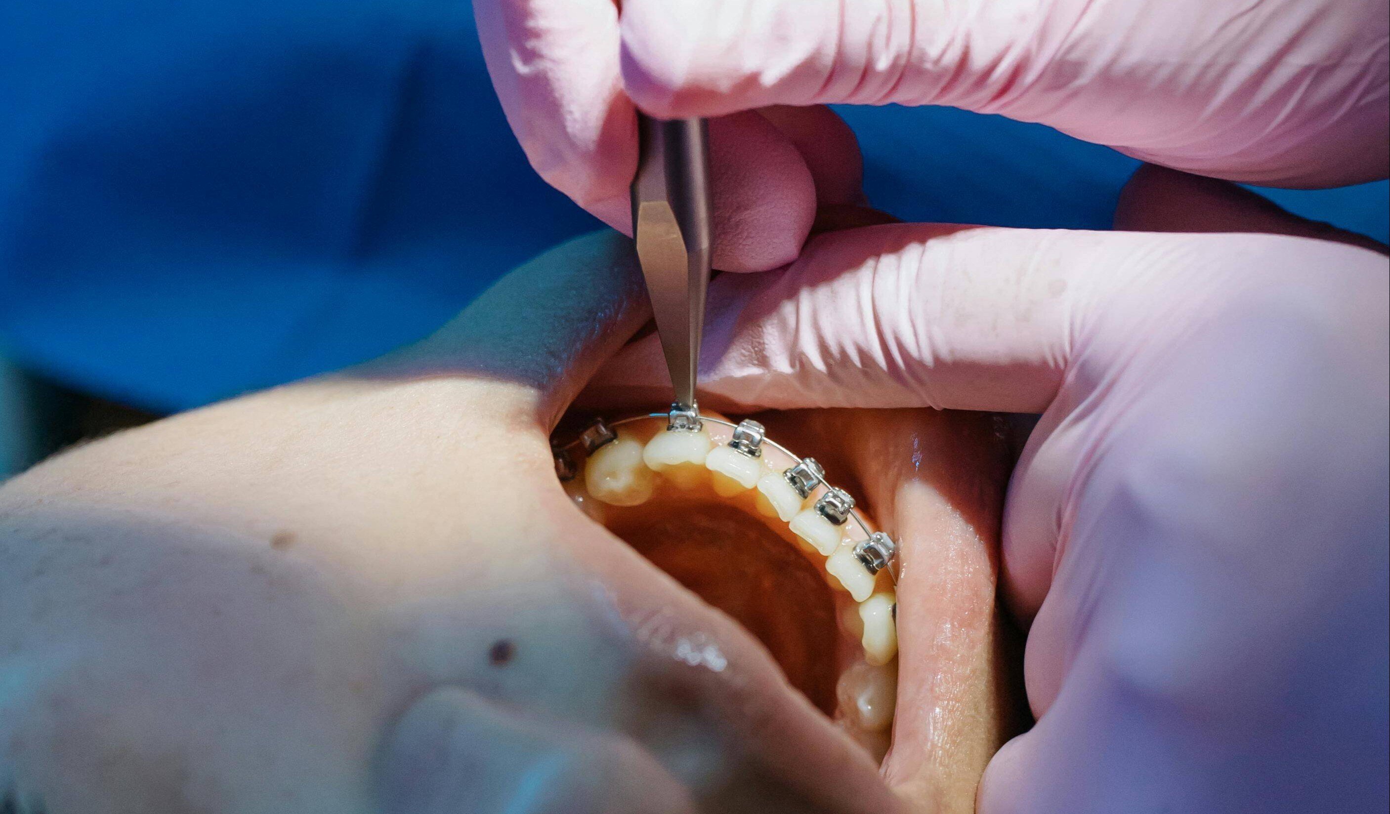 A person with braces at the dentist