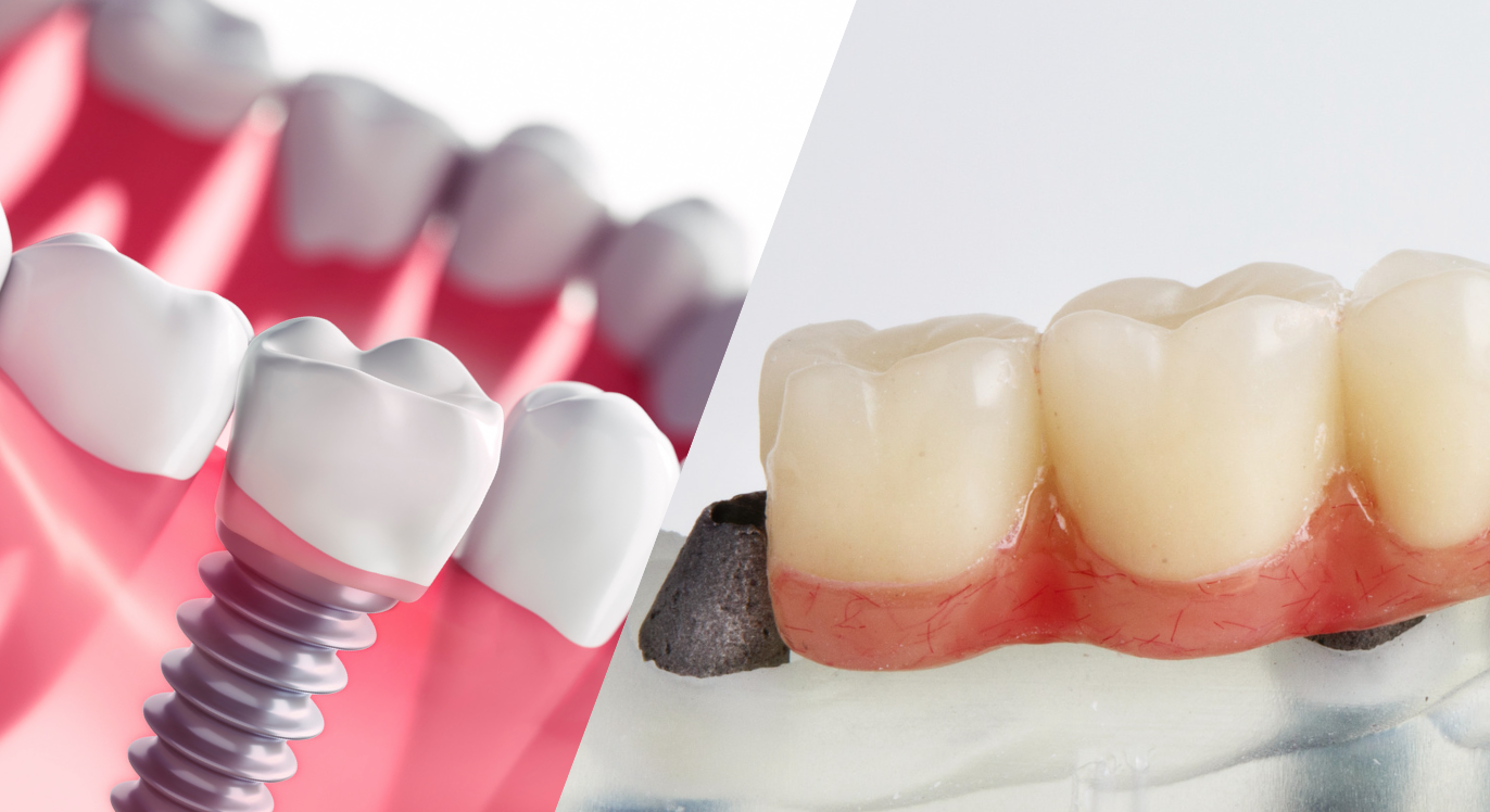 Dental Implants vs Bridge