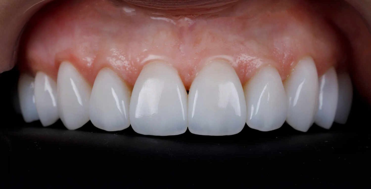 No Prep Veneers