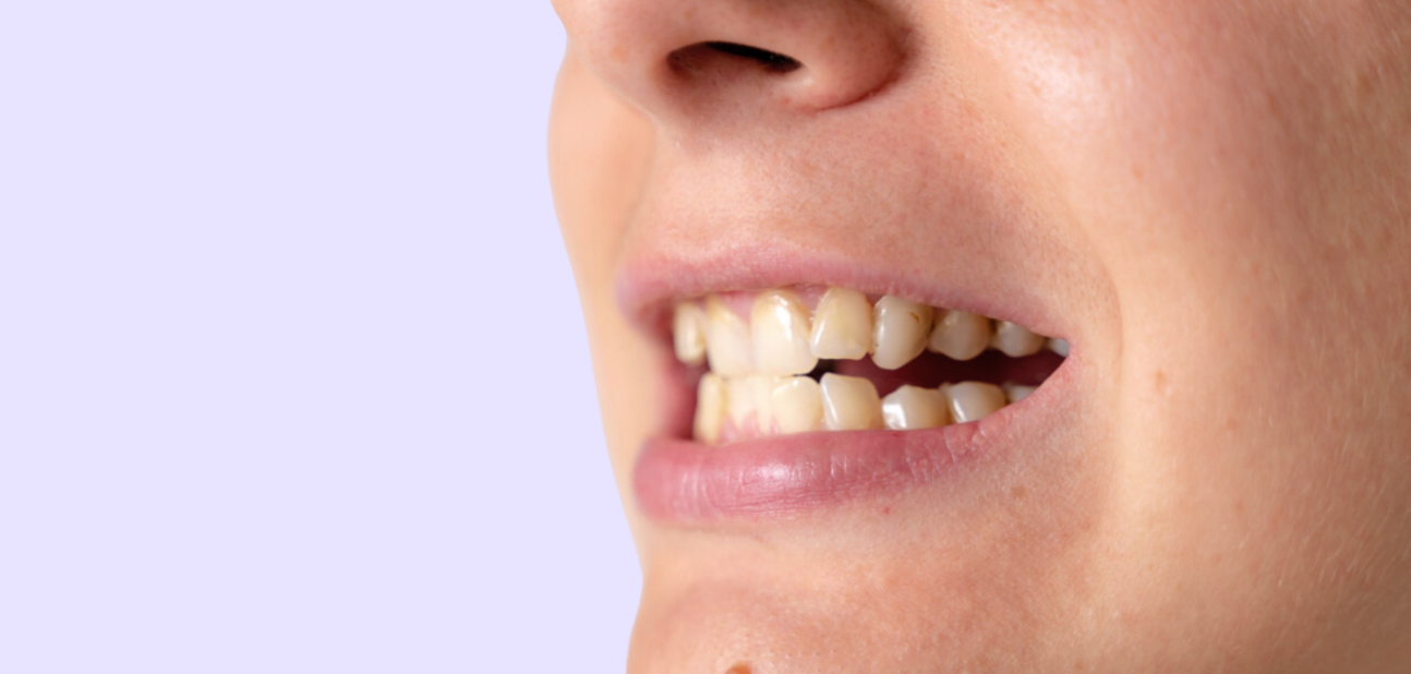 A person with crooked teeth