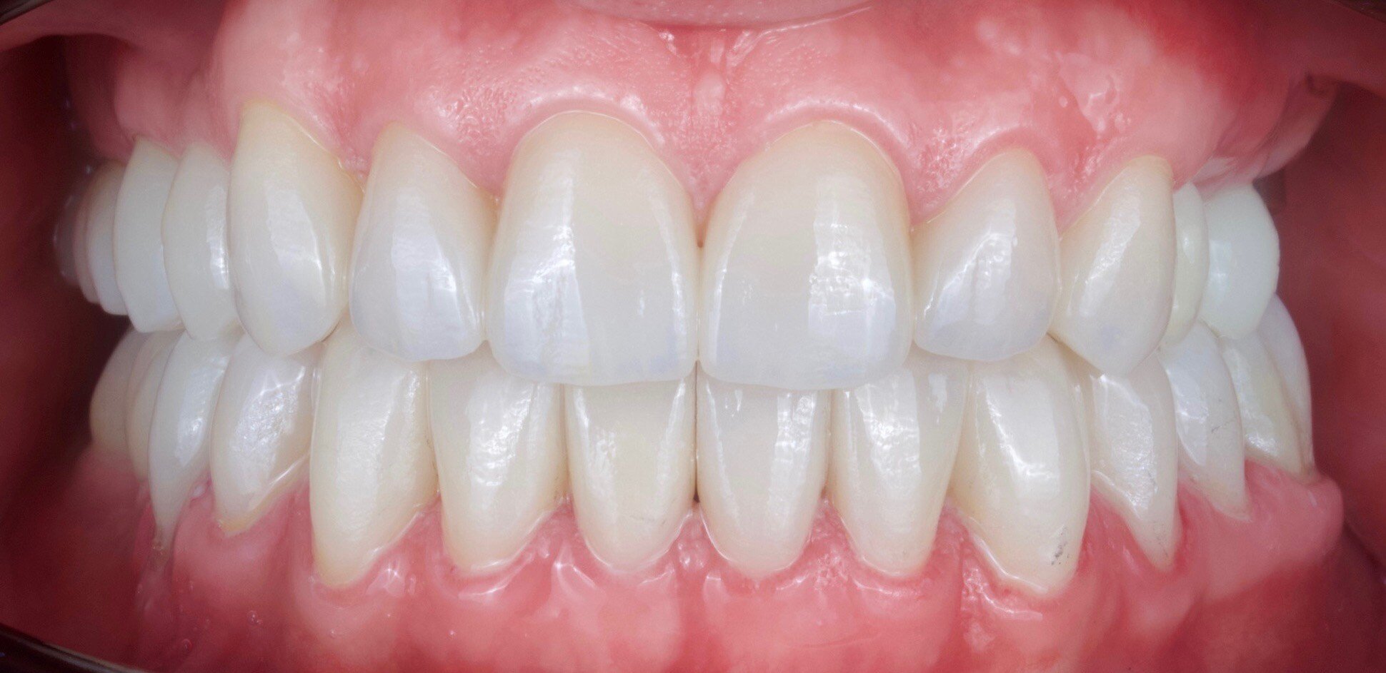 Person with veneers