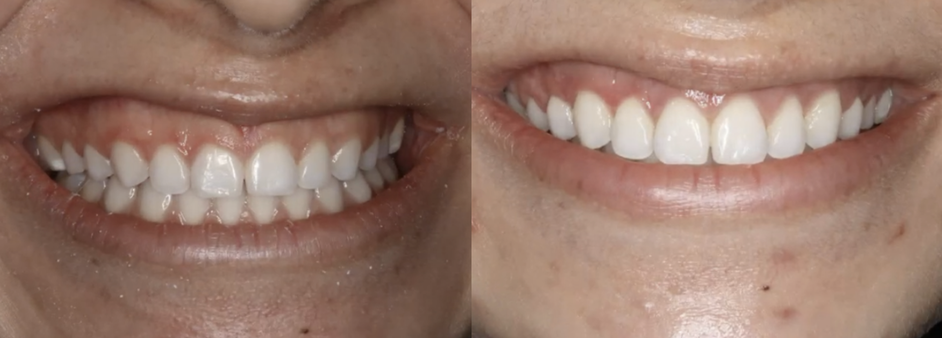 How Much Does It Cost To Fix A Gummy Smile? - NYC Smile Design