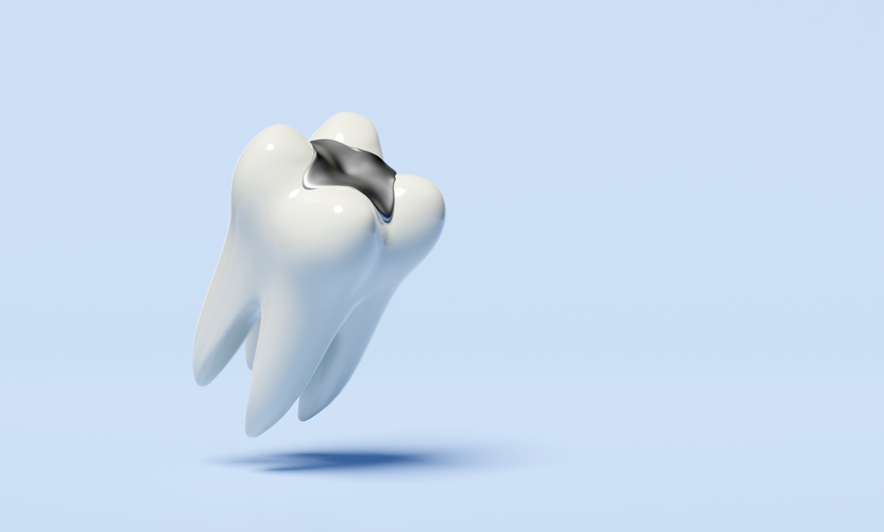 Mercury dental fillings