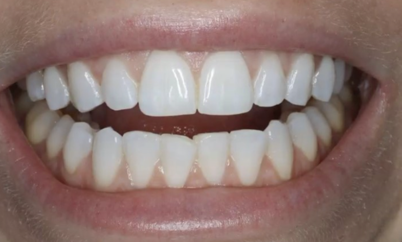 After tooth contouring