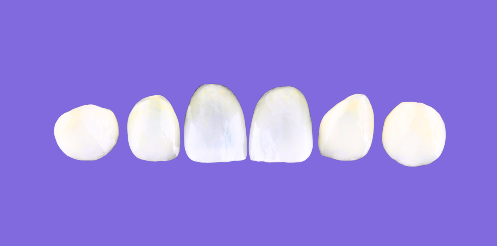 Different types of veneers