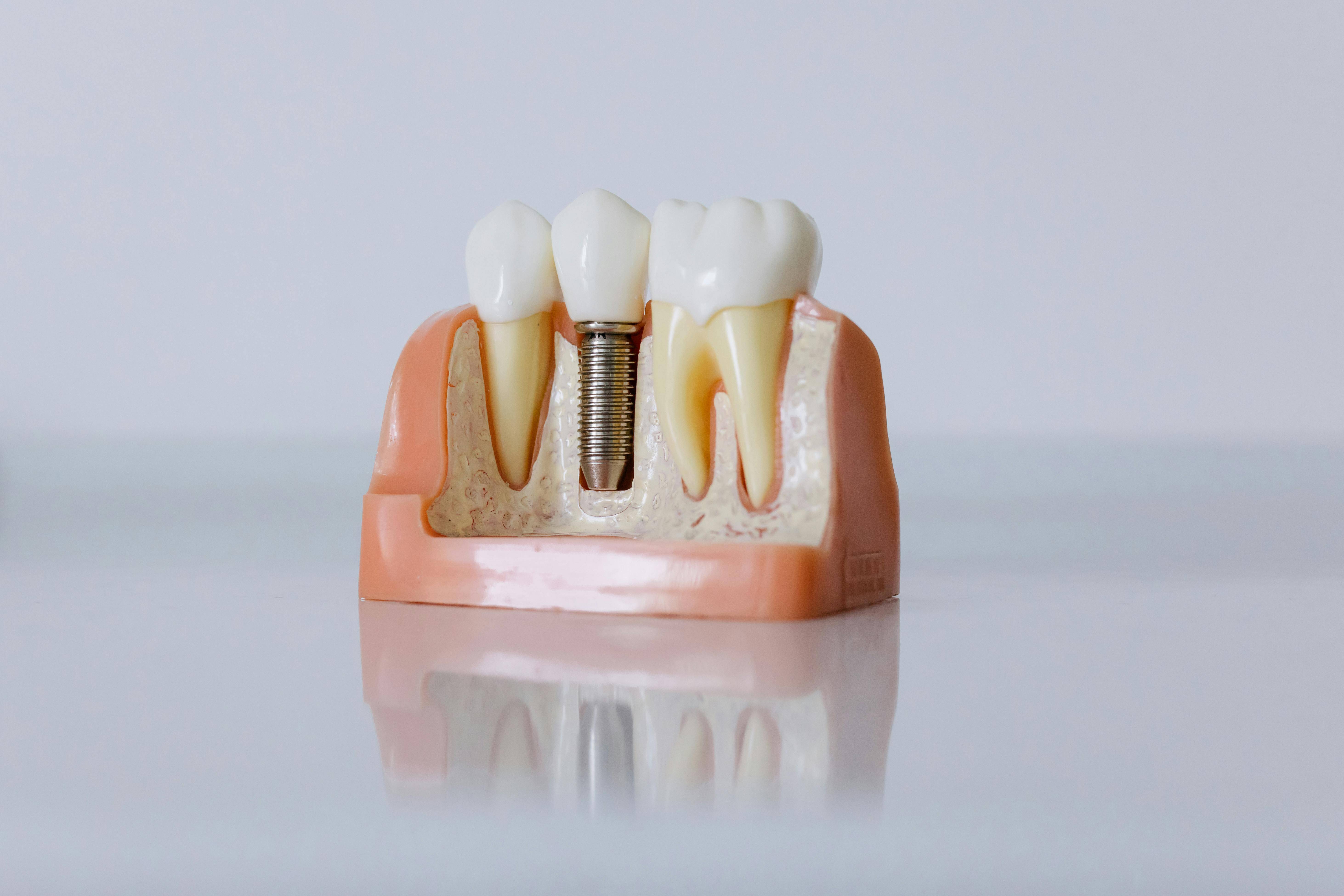 Dental implant diagram