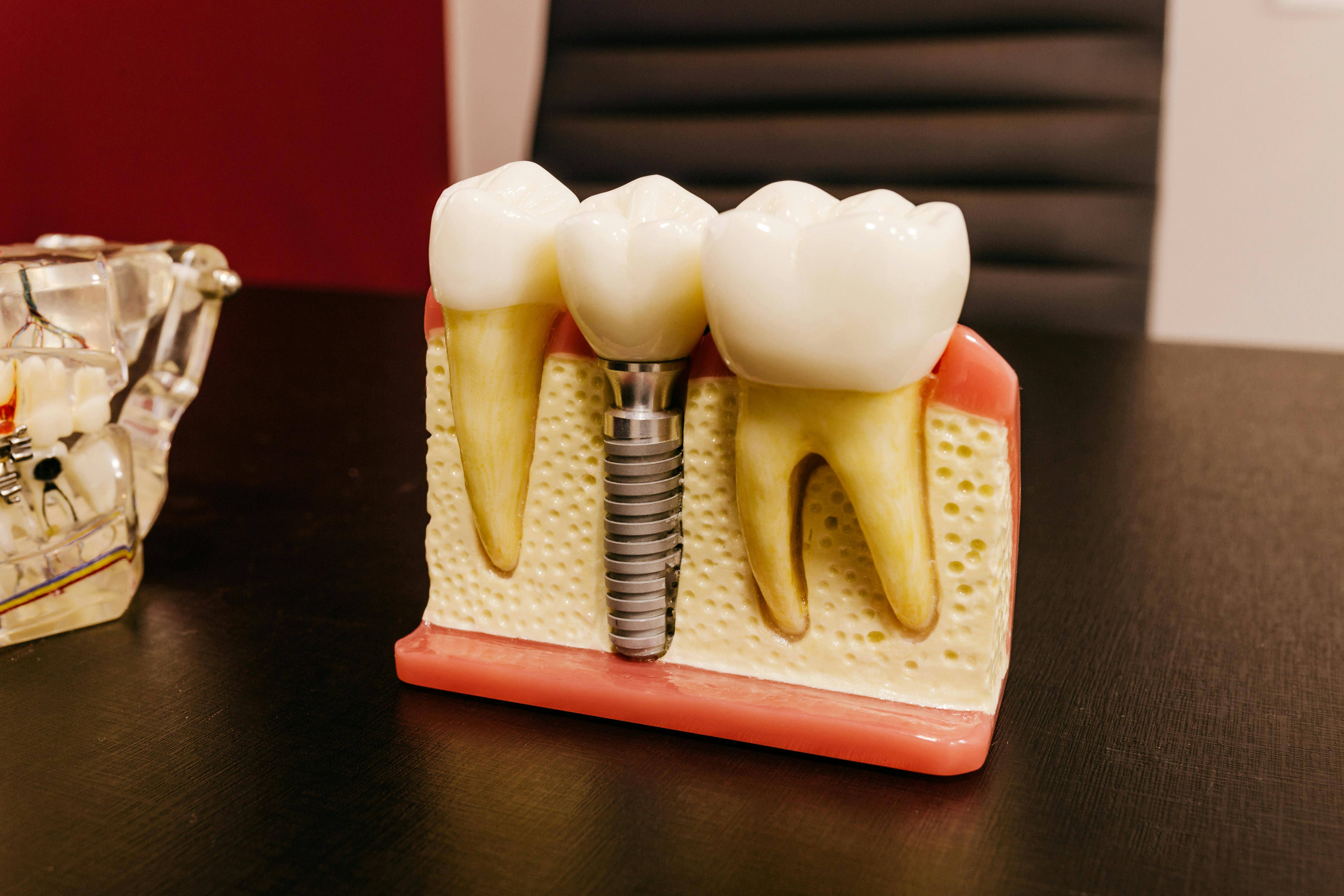 Dental Implant Display